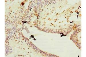 Immunohistochemistry of paraffin-embedded human breast cancer using ABIN7177750 at dilution of 1:100 (Plet1 Antikörper  (AA 28-218))