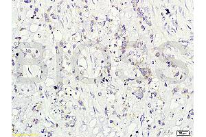 Formalin-fixed and paraffin-embedded human cervical carcinoma labeled with Rabbit Anti-CD160/By55 Polyclonal Antibody (ABIN741555), Unconjugated at 1:200 followed by conjugation to the secondary antibody and DAB staining.