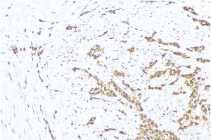 ABIN6276330 at 1/100 staining Human lung cancer tissue by IHC-P. (MTM1 Antikörper  (C-Term))