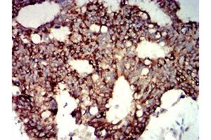 Immunohistochemical analysis of paraffin-embedded colon cancer tissues using P2RY14 mouse mAb with DAB staining. (P2RY14 Antikörper)