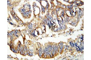 Anti-Calretinin antibody, IHC(P) IHC(P): Human Rectal Cancer Tissue