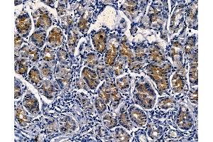 SPNS1 Antibody at 1/100 staining human pancreatic cancer and adjacent non-tumor tissue by IHC-P.