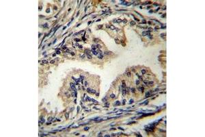 Formalin fixed, paraffin embedded human prostate carcinoma stained with STAMBP Antibody (C-term) followed by peroxidase conjugation of the secondary antibody and DAB staining. (STAMBP Antikörper  (C-Term))