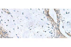 Immunohistochemistry of paraffin-embedded Human breast cancer tissue using PPIC Polyclonal Antibody at dilution of 1:50(x200) (PPIC Antikörper)