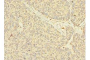 Immunohistochemistry of paraffin-embedded human ovarian cancer using ABIN7161035 at dilution of 1:100 (NANOS2 Antikörper  (AA 1-138))