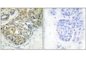 Immunohistochemical analysis of paraffin-embedded human breast carcinoma tissue using ACK1 (Phospho-Tyr284) antibody (left)or the same antibody preincubated with blocking peptide (right). (TNK2 Antikörper  (pTyr284))