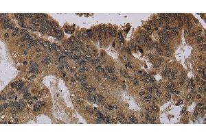 Immunohistochemistry of paraffin-embedded Human colon cancer using Histone H4 Polyclonal Antibody at dilution of 1:30 (Histone H4 Antikörper)