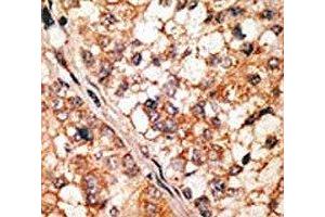IHC analysis of FFPE human hepatocarcinoma tissue stained with the Bim antibody (BIM Antikörper  (AA 130-165))