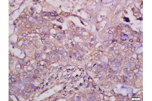 Formalin-fixed and paraffin embedded human lung carcinoma tissue labeled with Anti-MCSF Polyclonal Antibody, Unconjugated 1:400 followed by conjugation to the secondary antibody and DAB staining. (M-CSF/CSF1 Antikörper  (AA 201-300))