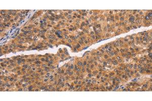 Immunohistochemistry of paraffin-embedded Human liver cancer tissue using NCAPG2 Polyclonal Antibody at dilution 1:50 (NCAPG2 Antikörper)