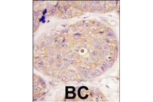 Formalin-fixed and paraffin-embedded human breast carcinoma tissue reacted with GGPS1 Antibody (C-term)((ABIN389056 and ABIN2839265)), which was peroxidase-conjugated to the secondary antibody, followed by DAB staining.