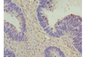 Immunohistochemistry of paraffin-embedded human ovarian cancer using ABIN7175357 at dilution of 1:100 (Vangl1 Antikörper  (AA 275-524))