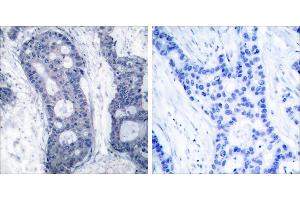 Peptide - +Immunohistochemical analysis of paraffin-embedded human breast carcinoma tissue using elF4E (Ab-209) antibody (#B7067). (EIF4E Antikörper  (Ser209))