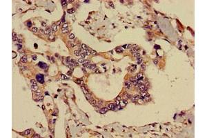 Immunohistochemistry of paraffin-embedded human pancreatic cancer using ABIN7143291 at dilution of 1:100 (ADK Antikörper  (AA 18-256))