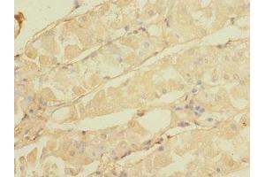 Immunohistochemistry of paraffin-embedded human gastric cancer using ABIN7146298 at dilution of 1:100 (CALHM3 Antikörper  (AA 201-350))