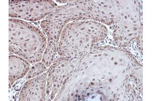 IHC-P Image Immunohistochemical analysis of paraffin-embedded Cal27 xenograft, using Aspartoacylase, antibody at 1:100 dilution. (ASPA Antikörper)