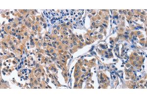 Immunohistochemistry of paraffin-embedded Human lung cancer tissue using INTS10 Polyclonal Antibody at dilution 1:50 (INTS10 Antikörper)