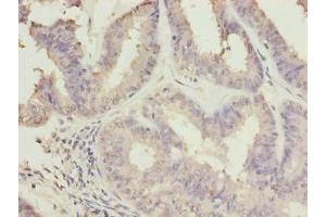 Immunohistochemistry of paraffin-embedded human endometrial cancer using ABIN7174707 at dilution of 1:100 (RPAP2 Antikörper  (AA 1-154))