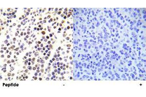 Immunohistochemical analysis of paraffin-embedded human malignant lymphoma tissue using HIST1H3E (phospho S28) polyclonal antibody .