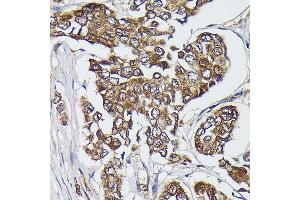 Immunohistochemistry of paraffin-embedded human breast cancer using FERMT2 Rabbit pAb (ABIN6131926, ABIN6140582, ABIN6140583 and ABIN6224757) at dilution of 1:300 (40x lens). (FERMT2 Antikörper  (AA 380-550))