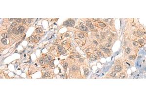 Immunohistochemistry of paraffin-embedded Human esophagus cancer tissue using GPR55 Polyclonal Antibody at dilution of 1:40(x200) (GPR55 Antikörper)