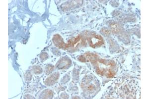 Formalin-fixed, paraffin-embedded human Breast Carcinoma stained with Major Vault Protein Rabbit Recombinant Monoclonal Antibody (VP2897R).