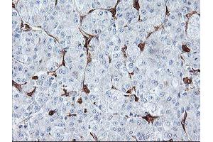 Immunohistochemical staining of paraffin-embedded Carcinoma of Human liver tissue using anti-BCAT1 mouse monoclonal antibody. (BCAT1 Antikörper)