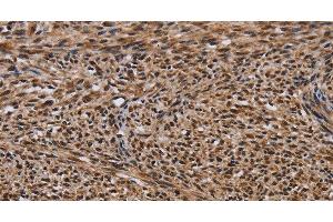 Immunohistochemistry of paraffin-embedded Human sarcoma using KIF1C Polyclonal Antibody at dilution of 1:60 (KIF1C Antikörper)