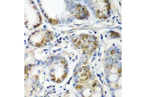 Immunohistochemistry of paraffin-embedded human colon carcinoma using CRYAA antibody (ABIN5973354) at dilution of 1/200 (40x lens). (CRYAA Antikörper)