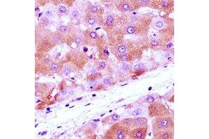 Immunohistochemical analysis of Anamorsin staining in human liver cancer formalin fixed paraffin embedded tissue section. (CIAPIN1 Antikörper)