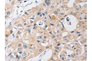 The image on the left is immunohistochemistry of paraffin-embedded Human lung cancer tissue using ABIN7191756(P2RY11 Antibody) at dilution 1/40, on the right is treated with synthetic peptide. (P2RY11 Antikörper)