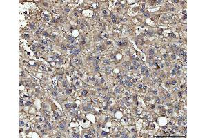 IHC analysis of ME1 using anti-ME1 antibody (ABIN7599485). (ME1 Antikörper  (AA 1-572))