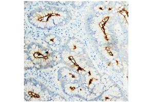 Immunohistochemistry (IHC) image for anti-Carcinoembryonic Antigen-Related Cell Adhesion Molecule 5 (CEACAM5) antibody (ABIN1106531) (CEACAM5 Antikörper)