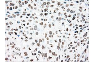 Immunohistochemical staining of paraffin-embedded Adenocarcinoma of colon tissue using anti-PLK1mouse monoclonal antibody. (PLK1 Antikörper)
