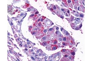 Anti-OPN5 antibody IHC of human Ovary, Carcinoma.