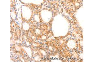Immunohistochemistry of Human thyroid cancer using NAP1L1 Polyclonal Antibody at dilution of 1:70 (NAP1L1 Antikörper)
