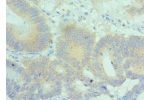 Immunohistochemistry of paraffin-embedded human colon cancer using ABIN7169161 at dilution of 1:100 (PLK2 Antikörper  (AA 336-685))