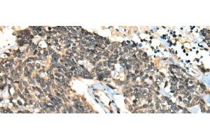 Immunohistochemistry of paraffin-embedded Human lung cancer tissue using CCNB1IP1 Polyclonal Antibody at dilution of 1:30(x200) (CCNB1IP1 Antikörper)