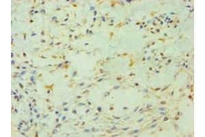 Immunohistochemistry of paraffin-embedded human breast cancer using ABIN7163201 at dilution of 1:100 (PIP4K2B Antikörper  (AA 1-270))