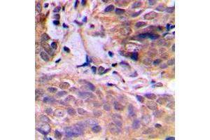 Immunohistochemical analysis of HuB staining in human breast cancer formalin fixed paraffin embedded tissue section. (HuB (Center) Antikörper)