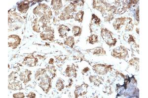Formalin-fixed, paraffin-embedded human Breast Carcinoma stained with NME2 / nm23-H2 Mouse Monoclonal Antibody (CPTC-NME2-2).