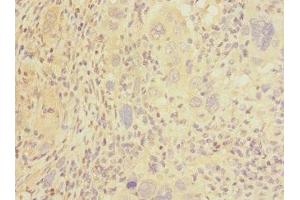 Immunohistochemistry of paraffin-embedded human liver cancer using ABIN7146045 at dilution of 1:100 (C-Type Lectin Domain Family 1, Member B (CLEC1B) (AA 55-229) Antikörper)
