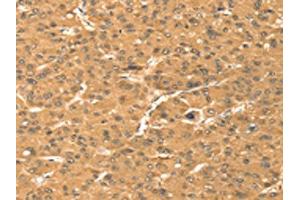 The image on the left is immunohistochemistry of paraffin-embedded Human liver cancer tissue using ABIN7131392(TMEM123 Antibody) at dilution 1/25, on the right is treated with fusion protein. (TMEM123 Antikörper)
