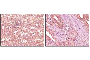Immunohistochemical analysis of paraffin-embedded human skin carcinoma (left) and pancreas carcinoma (right) tissue, showing cytoplasmic localization using EphA2 mouse mAb with DAB staining. (EPH Receptor A2 Antikörper)
