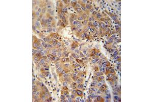 VP4 antibody (Center) (ABIN652042 and ABIN2840516) immunohistochemistry analysis in formalin fixed and paraffin embedded human hepatocarcinoma followed by peroxidase conjugation of the secondary antibody and DAB staining. (VAMP4 Antikörper  (AA 16-45))