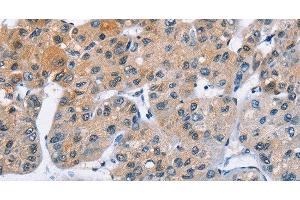 Immunohistochemistry of paraffin-embedded Human liver cancer using ATXN1 Polyclonal Antibody at dilution of 1:40 (Ataxin 1 Antikörper)