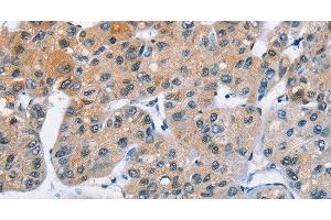 Immunohistochemistry of paraffin-embedded Human liver cancer using ATXN1 Polyclonal Antibody at dilution of 1:40 (Ataxin 1 Antikörper)