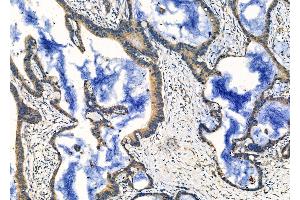 ABIN6260218 and ABIN6276684 at 1/100 staining Human colorectal cancer by IHC-P. (Butyrylcholinesterase Antikörper  (C-Term))