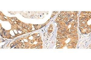 Immunohistochemistry of paraffin-embedded Human gastric cancer tissue using NOL8 Polyclonal Antibody at dilution of 1:40(x200)