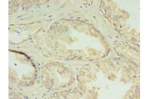 Immunohistochemistry of paraffin-embedded human prostate cancer using ABIN7147537 at dilution of 1:100 (CHMP7 Antikörper  (AA 1-290))